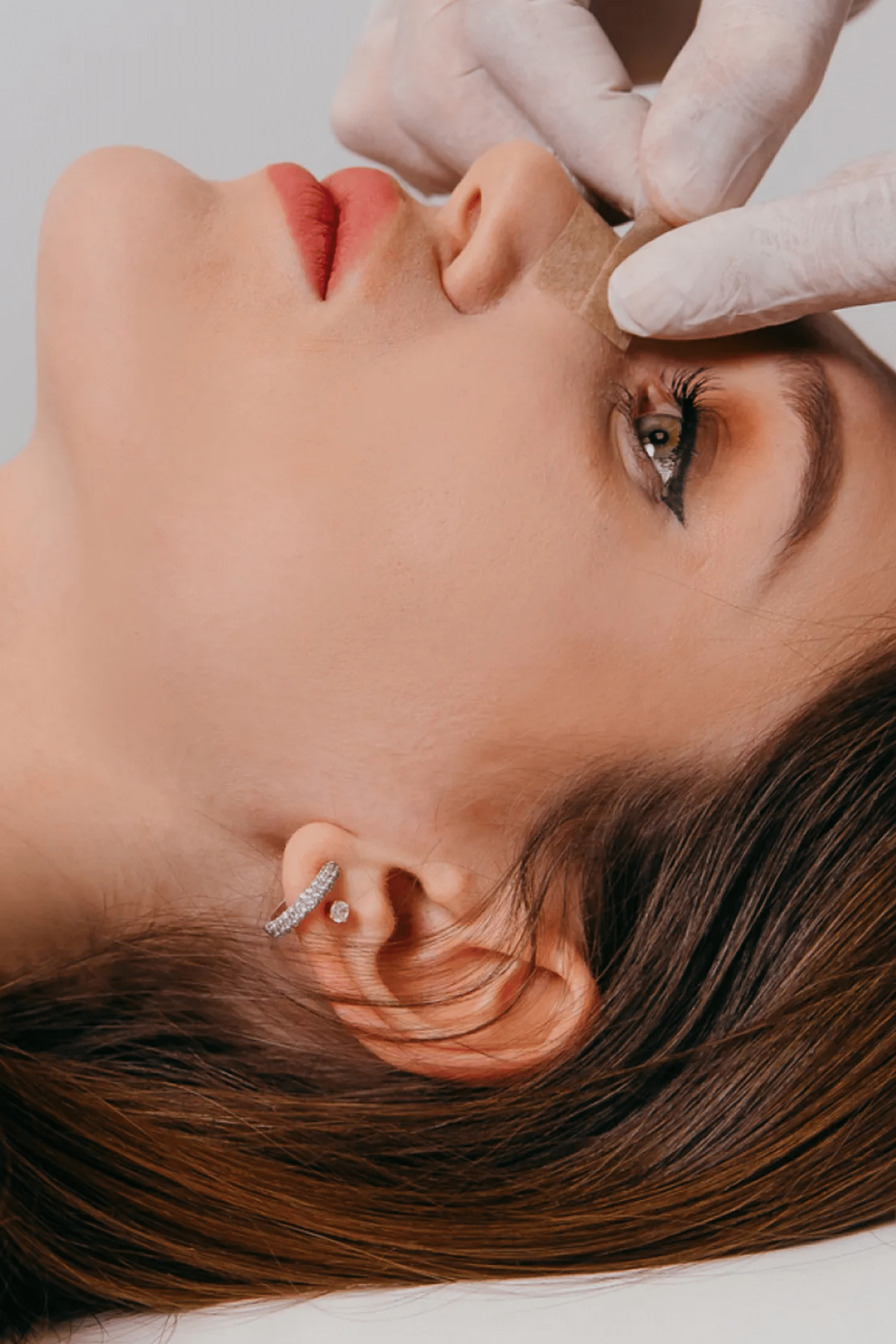 Closed rhinoplasty technique diagram