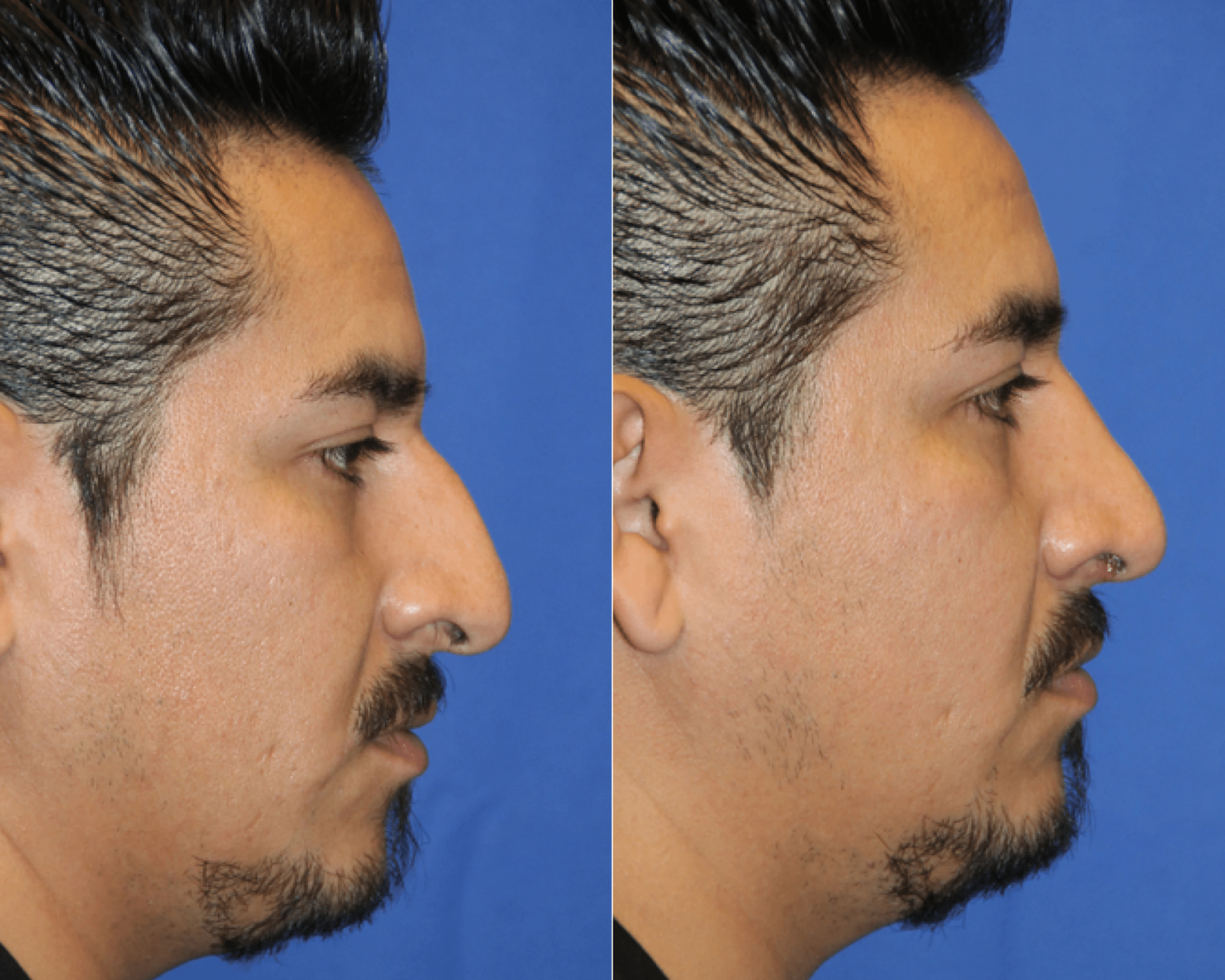 Rhinoplasty before and after &mdash; dorsal hump removal