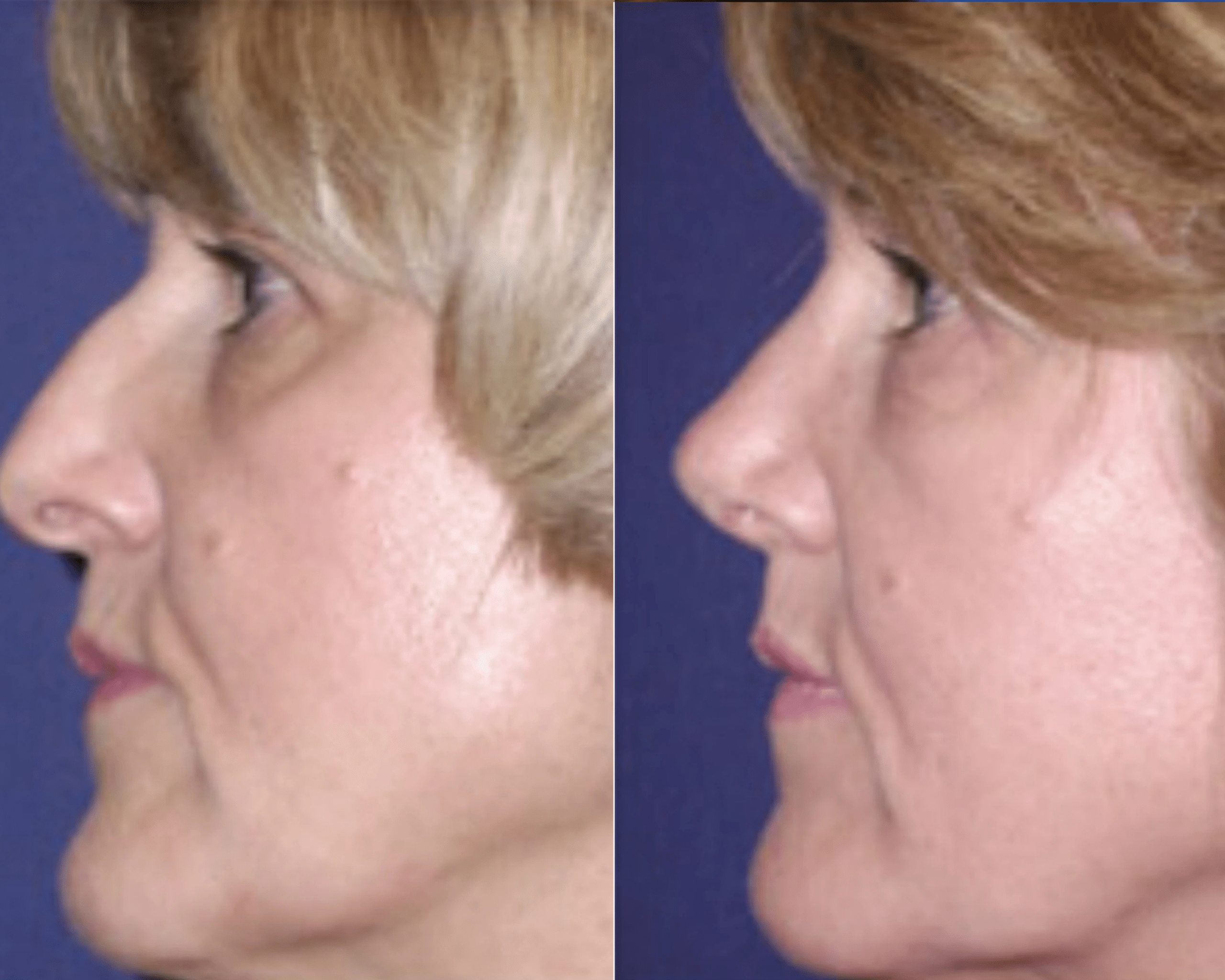 Rhinoplasty before and after &mdash; revision rhinoplasty