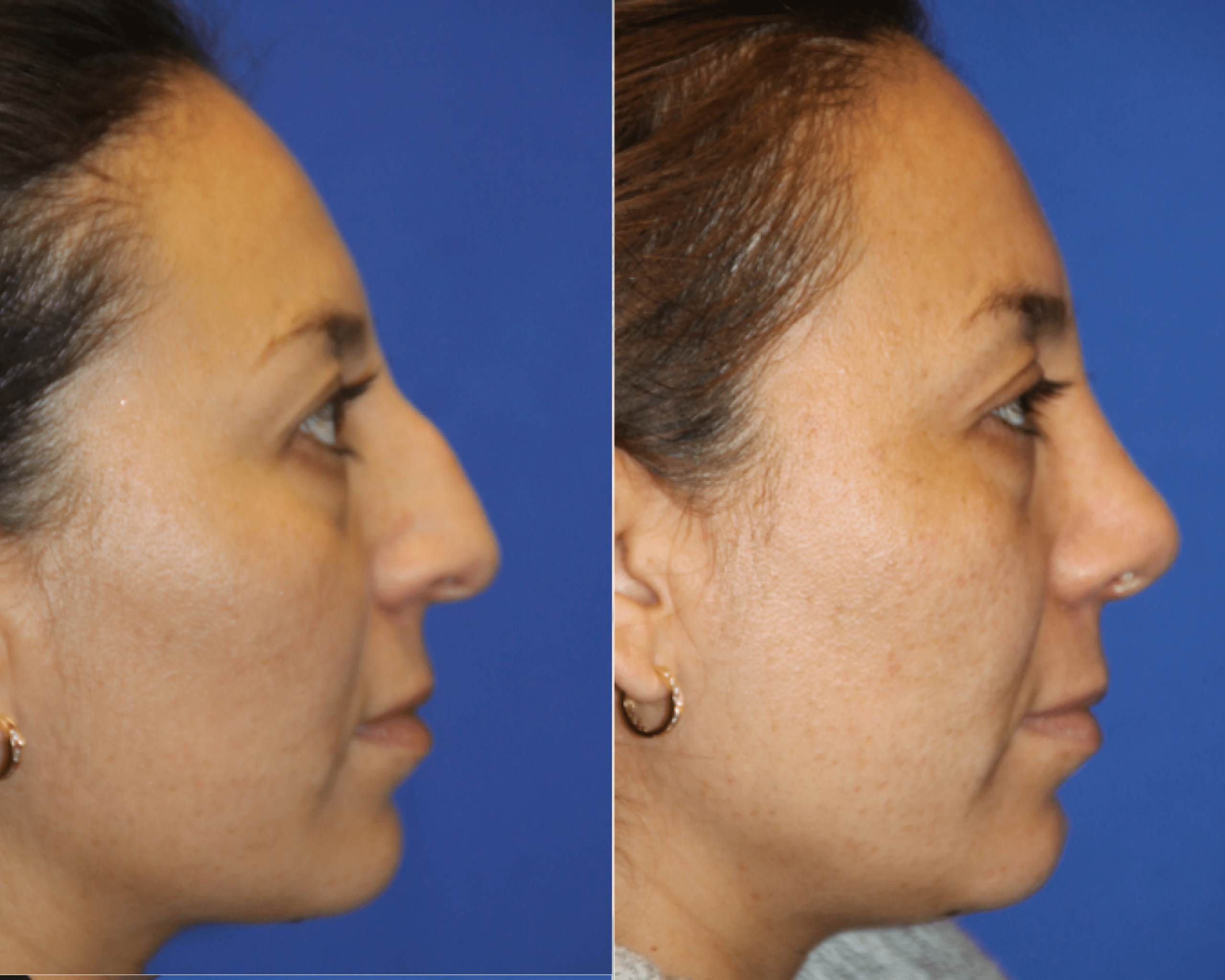 Rhinoplasty before and after &mdash; straightened nasal bridge
