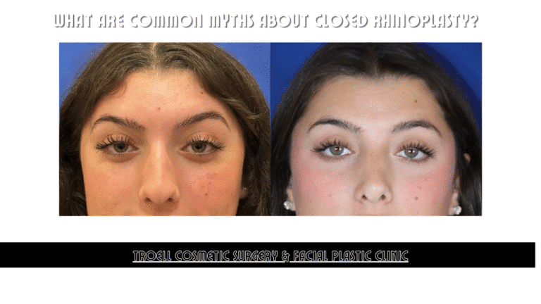 Myths about rhinoplasty in LV