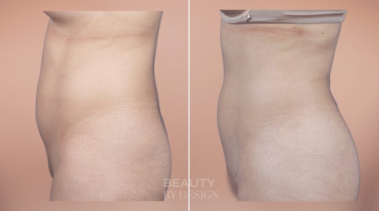 Body Contouring result &mdash; Patient 6