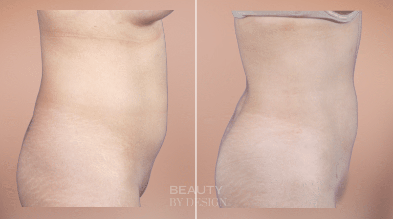 Body Contouring result &mdash; Patient 7