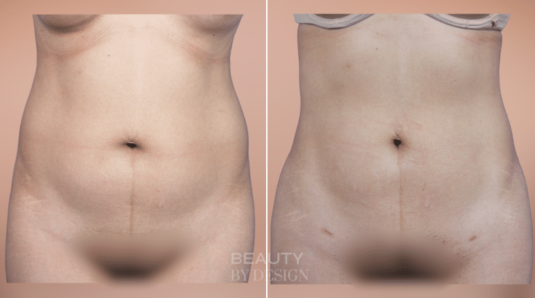 Body Contouring result &mdash; Patient 5