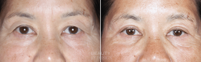 Upper blepharoplasty before and after &mdash; Patient 1, front view