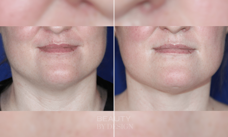 Jawline front view &mdash; Patient 1 &mdash; Jawline Liposuction