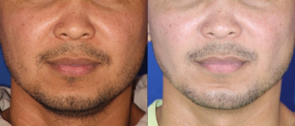 Chin surgery before and after &mdash; Patient 1, side profile