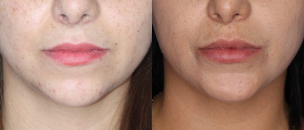 Chin surgery before and after &mdash; Patient 3, side profile