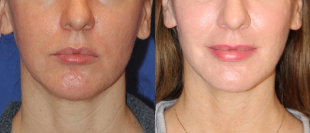 Jowl surgery before and after &mdash; real patient result