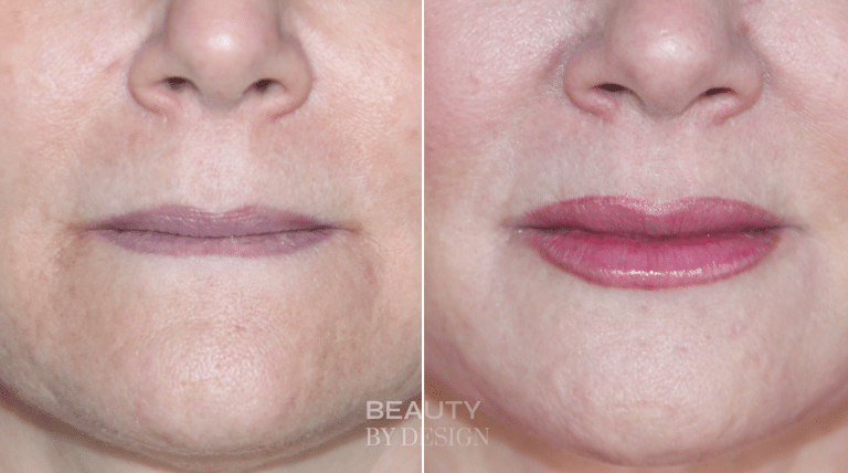 Lip Augmentation result &mdash; Patient 1