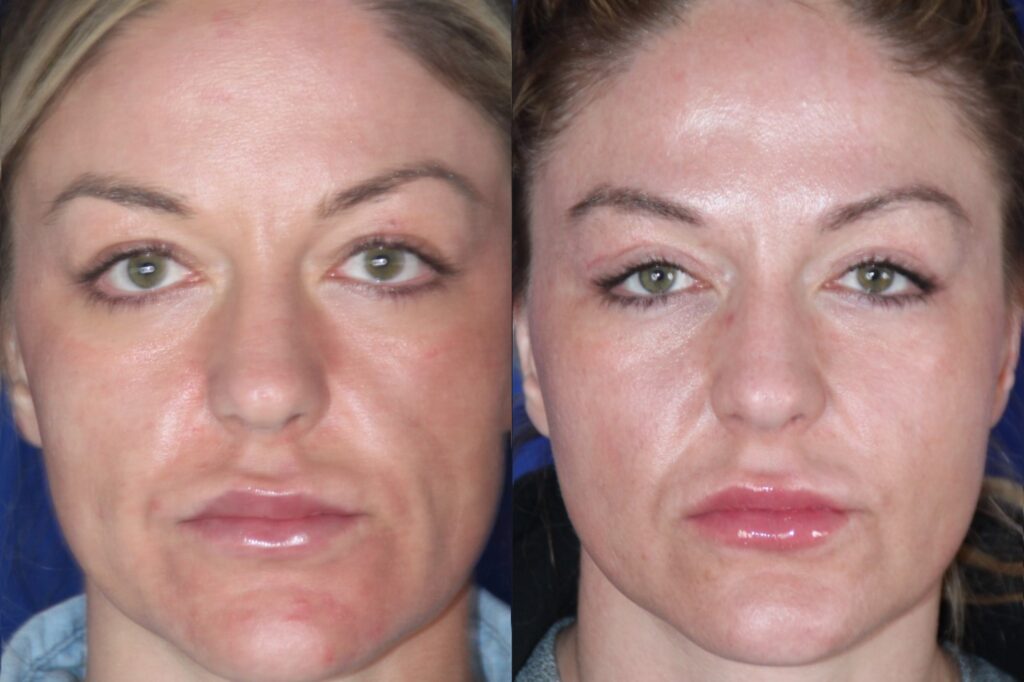 Cheek Implants result &mdash; Patient 4