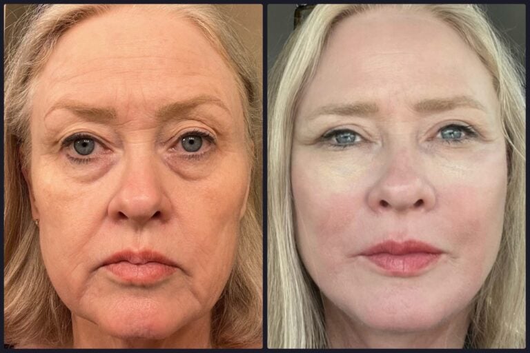 Cheek implant before and after &mdash; real patient result