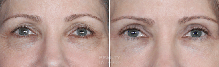 Upper and lower blepharoplasty before and after &mdash; Patient 7