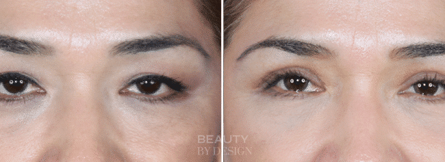 Upper blepharoplasty before and after &mdash; Patient 2, front view
