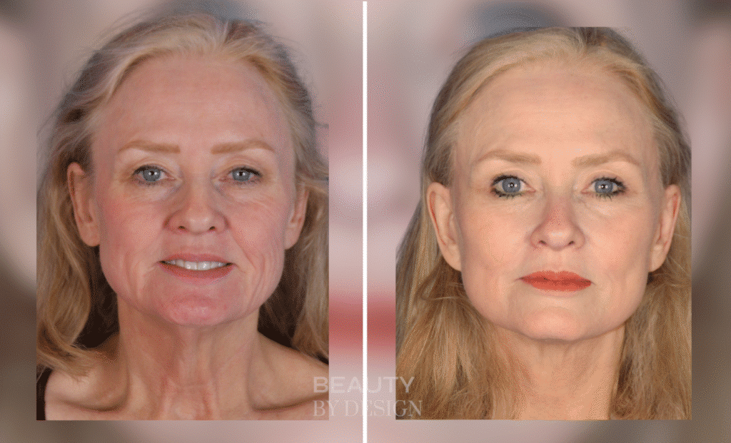 Facelift before and after results by Dr. Troell