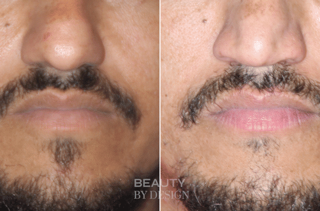 Lip Augmentation result &mdash; Patient 2