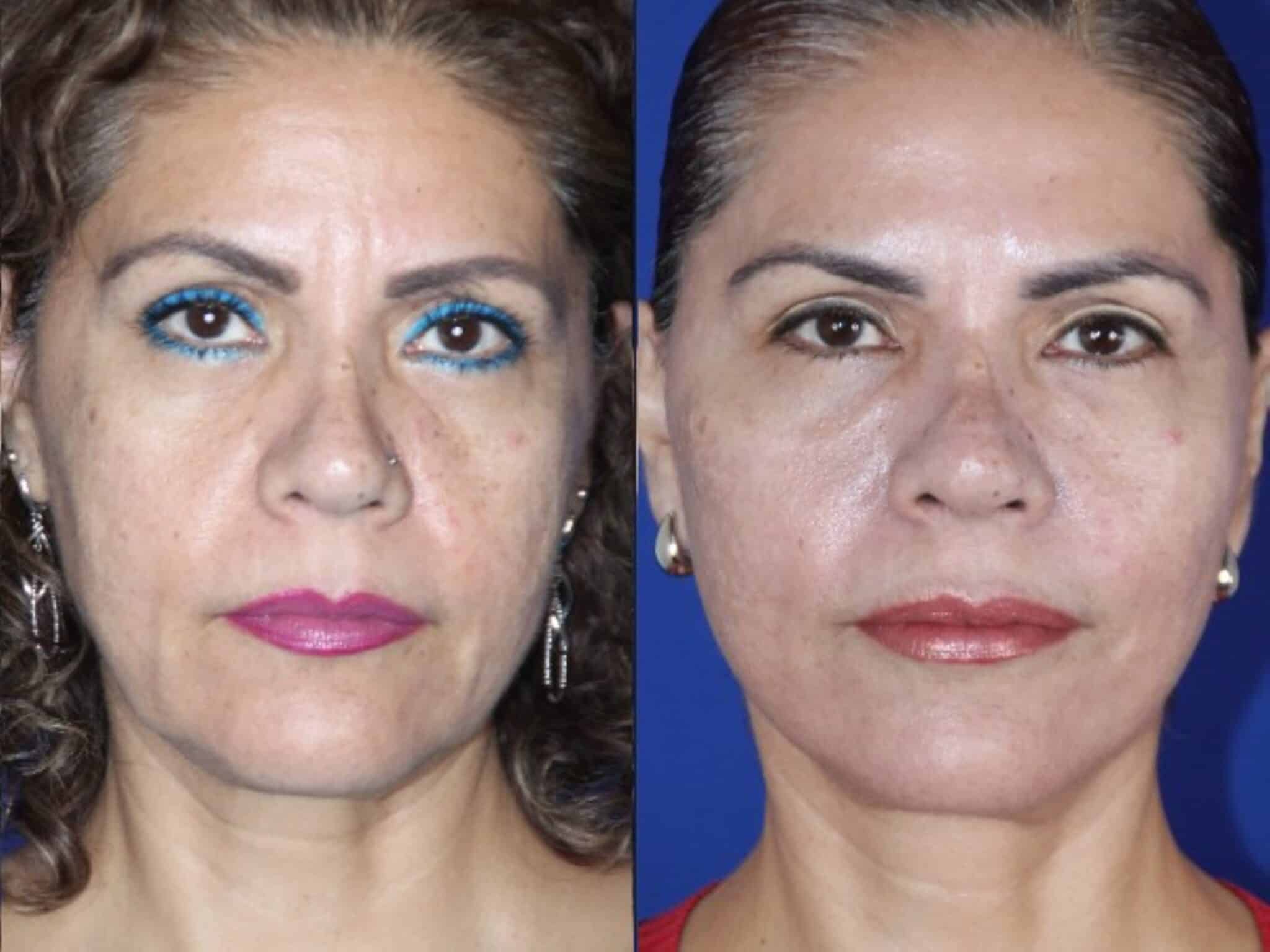Facelift front view &mdash; Patient 2 &mdash; Facelift & Neck Lift