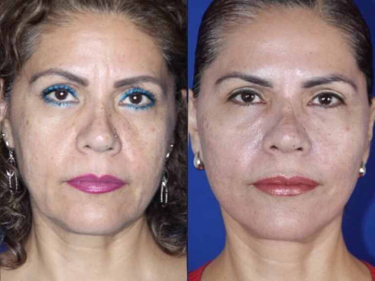 Facelift scarring &mdash; what to expect