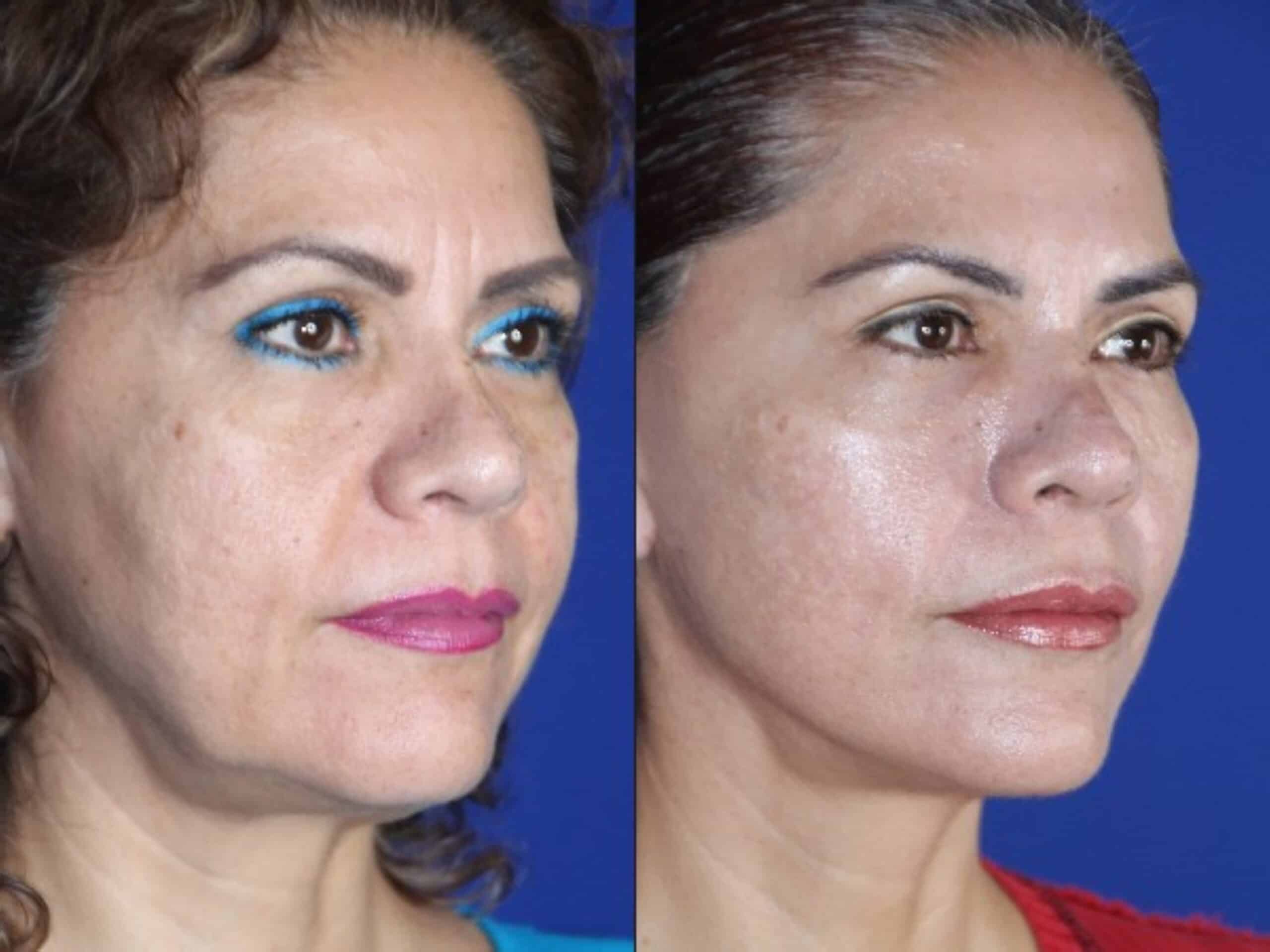 Facelift three-quarter view &mdash; Patient 2 &mdash; Facelift & Neck Lift