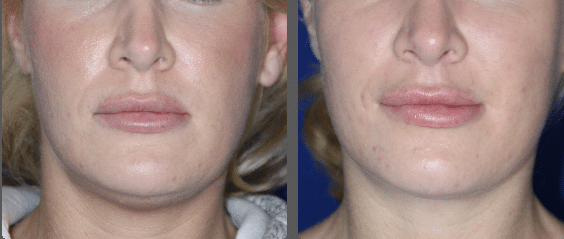 Jawline before & after &mdash; Patient 2 &mdash; Lower Face Contouring