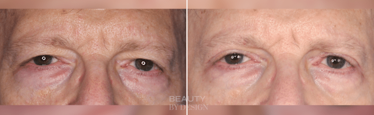 Upper and lower blepharoplasty before and after &mdash; Patient 4