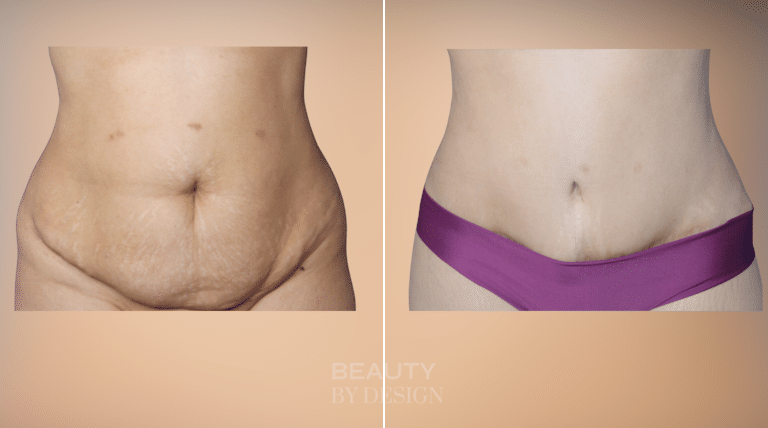 Body Contouring result &mdash; Patient 8