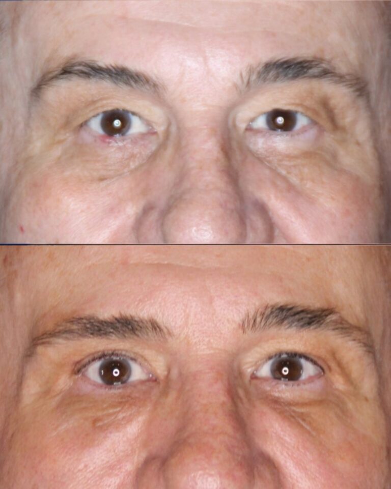Upper blepharoplasty before and after &mdash; Patient 8