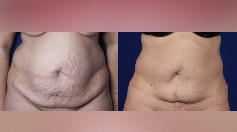 Browse all body and breast procedure galleries