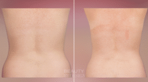 Body Contouring result &mdash; Patient 4