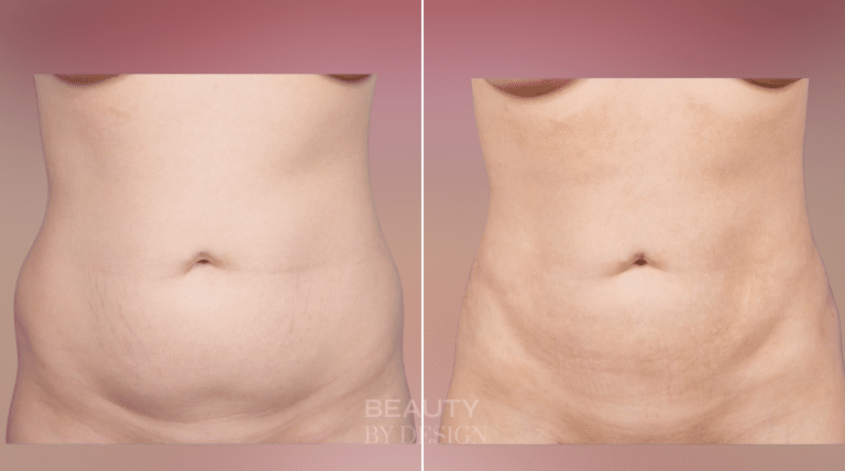 Body Contouring result &mdash; Patient 1