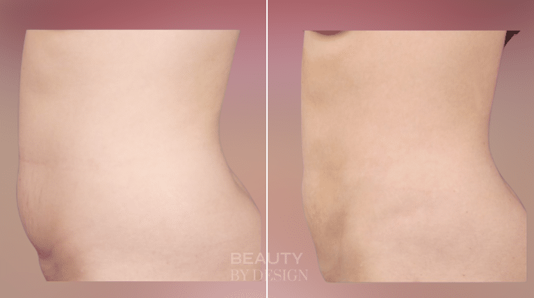 Body Contouring result &mdash; Patient 3