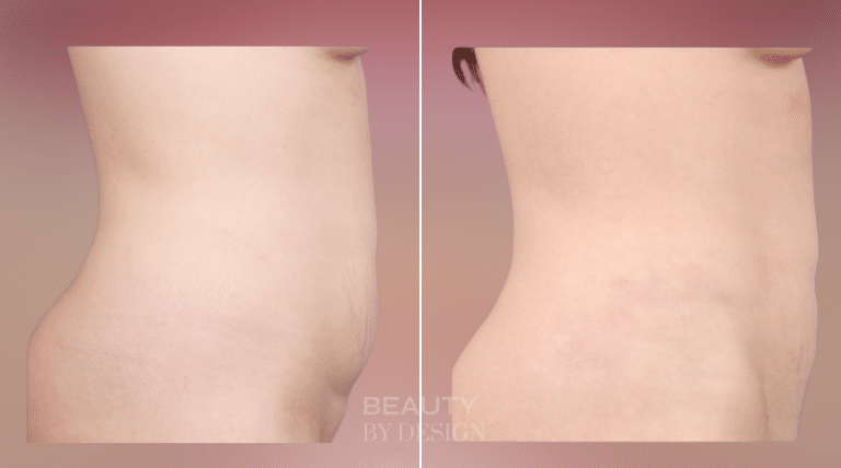 Body Contouring result &mdash; Patient 2