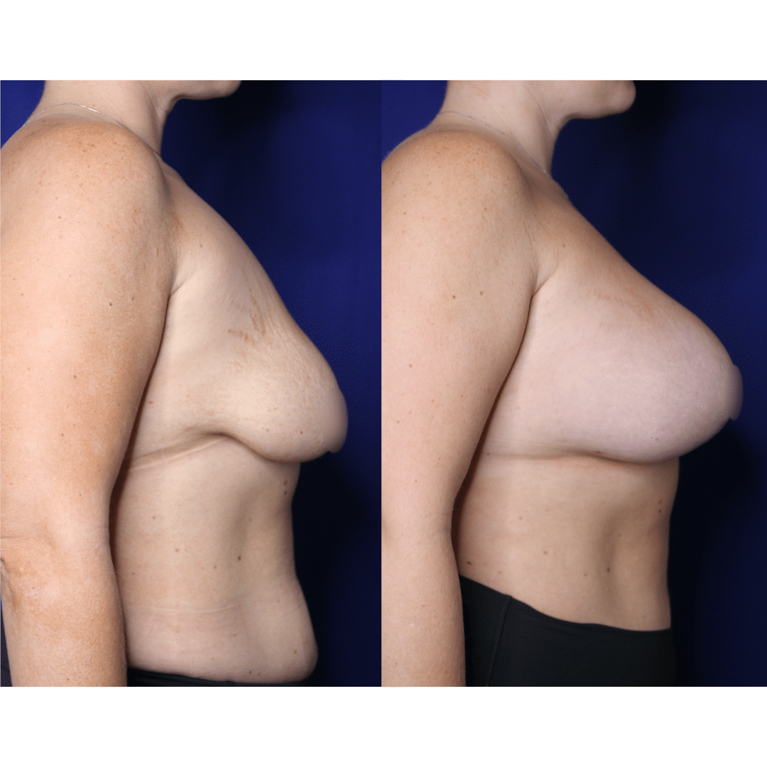 Before and after breast augmentation side-by-side example (individual results vary)