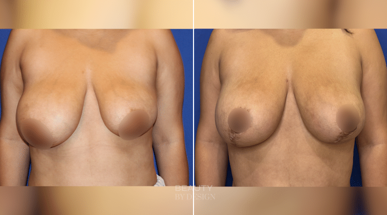 Breast lift before and after &mdash; front view