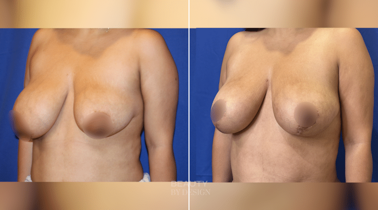 Breast Revision result &mdash; Patient 4
