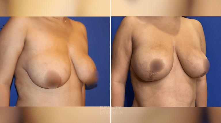 Breast Revision result &mdash; Patient 5