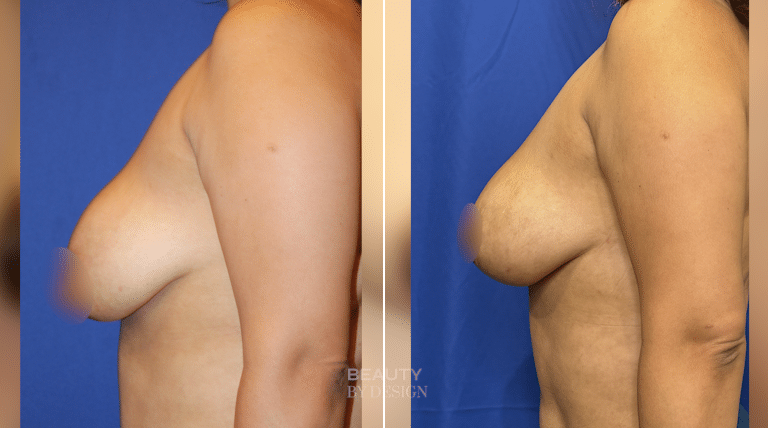 Breast Revision result &mdash; Patient 3