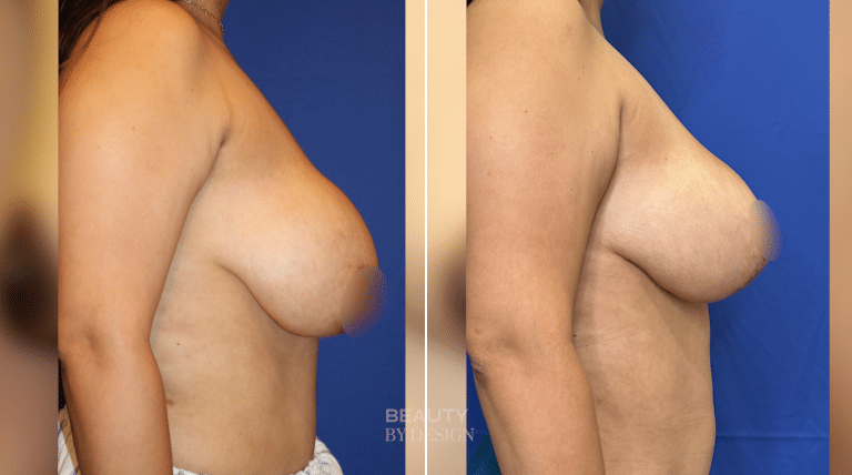Breast Revision result &mdash; Patient 2