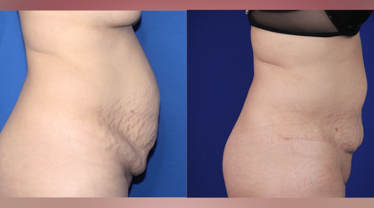 Tummy tuck before and after &mdash; Patient 1, side profile