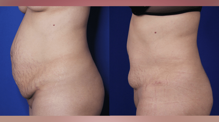 Tummy tuck before and after &mdash; Patient 1, alternate side