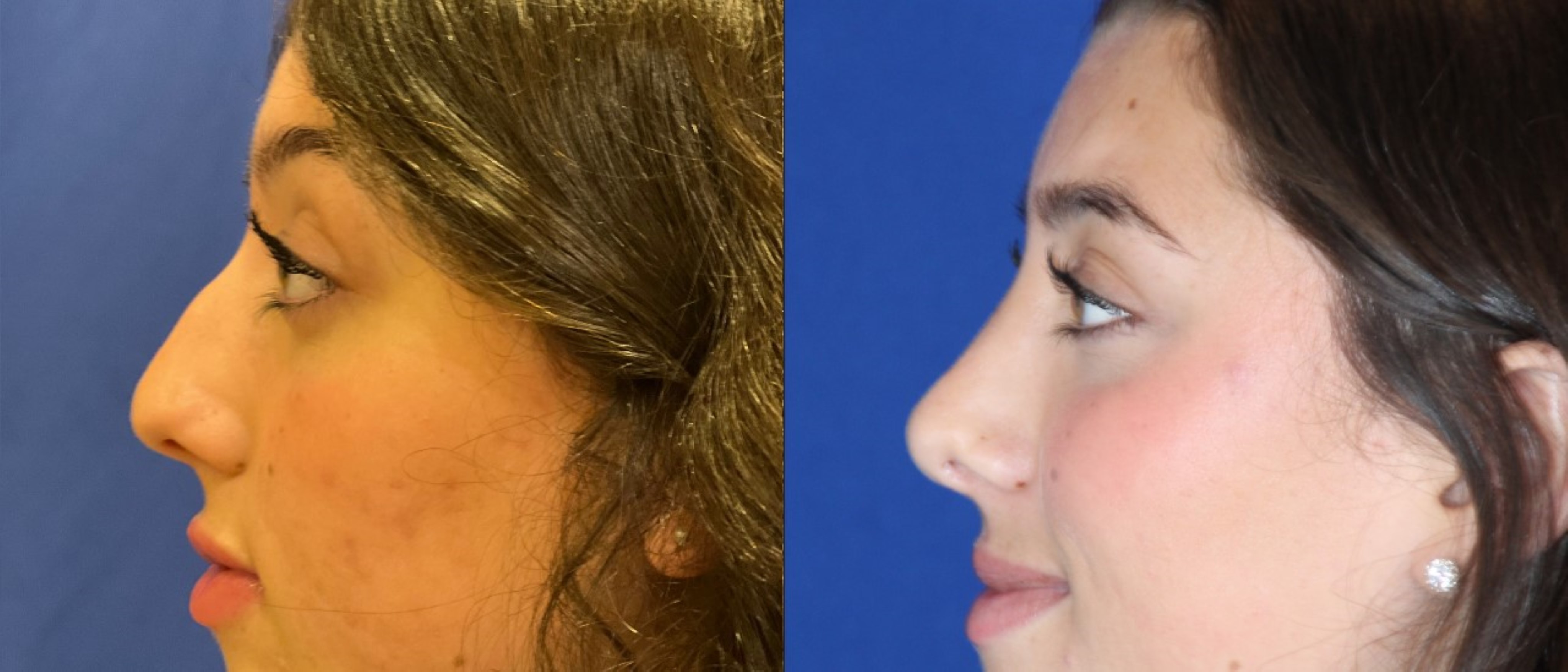 Rhinoplasty side profile &mdash; Patient 1 &mdash; Cosmetic Rhinoplasty
