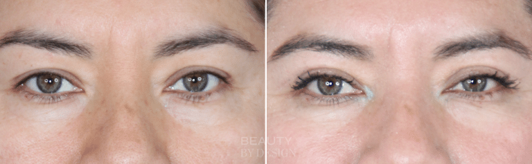 Lower blepharoplasty before and after &mdash; Patient 3