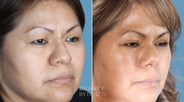 Rhinoplasty three-quarter view &mdash; Patient 3 &mdash; Natural Nose Reshaping