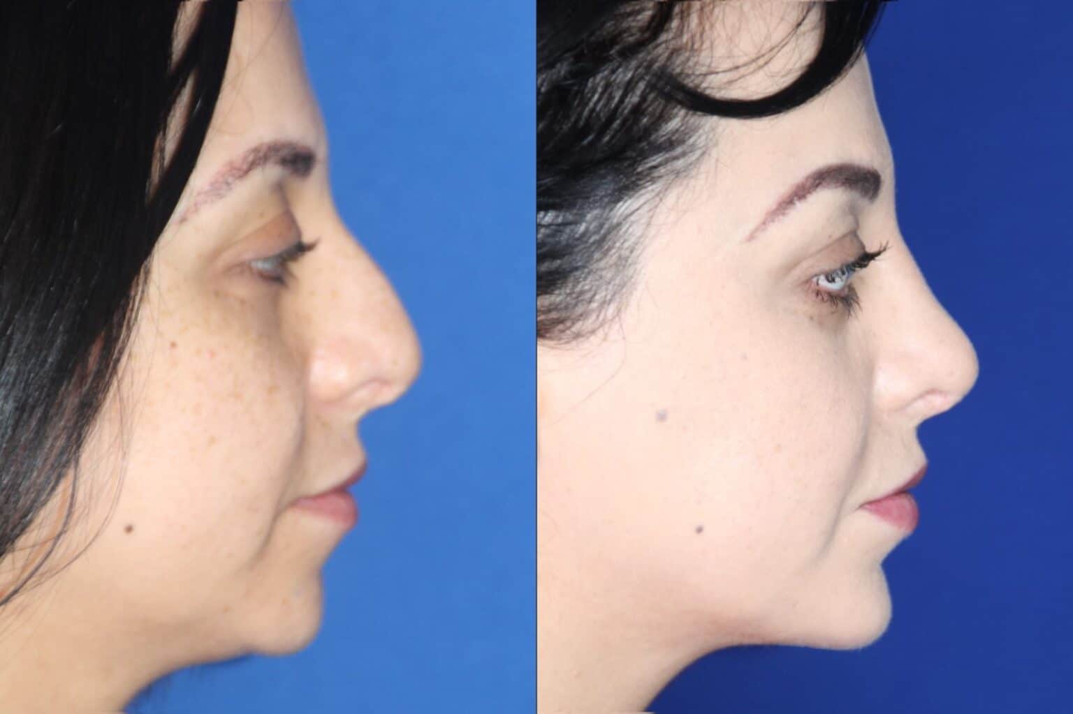 Rhinoplasty and chin implant before and after, right profile &mdash; a woman's dorsal hump and under-projected chin before, a refined nasal profile with stronger forward chin projection after rhinoplasty combined with a chin implant by Dr. Robert J. Troell, Las Vegas. Actual patient; individual results vary.
