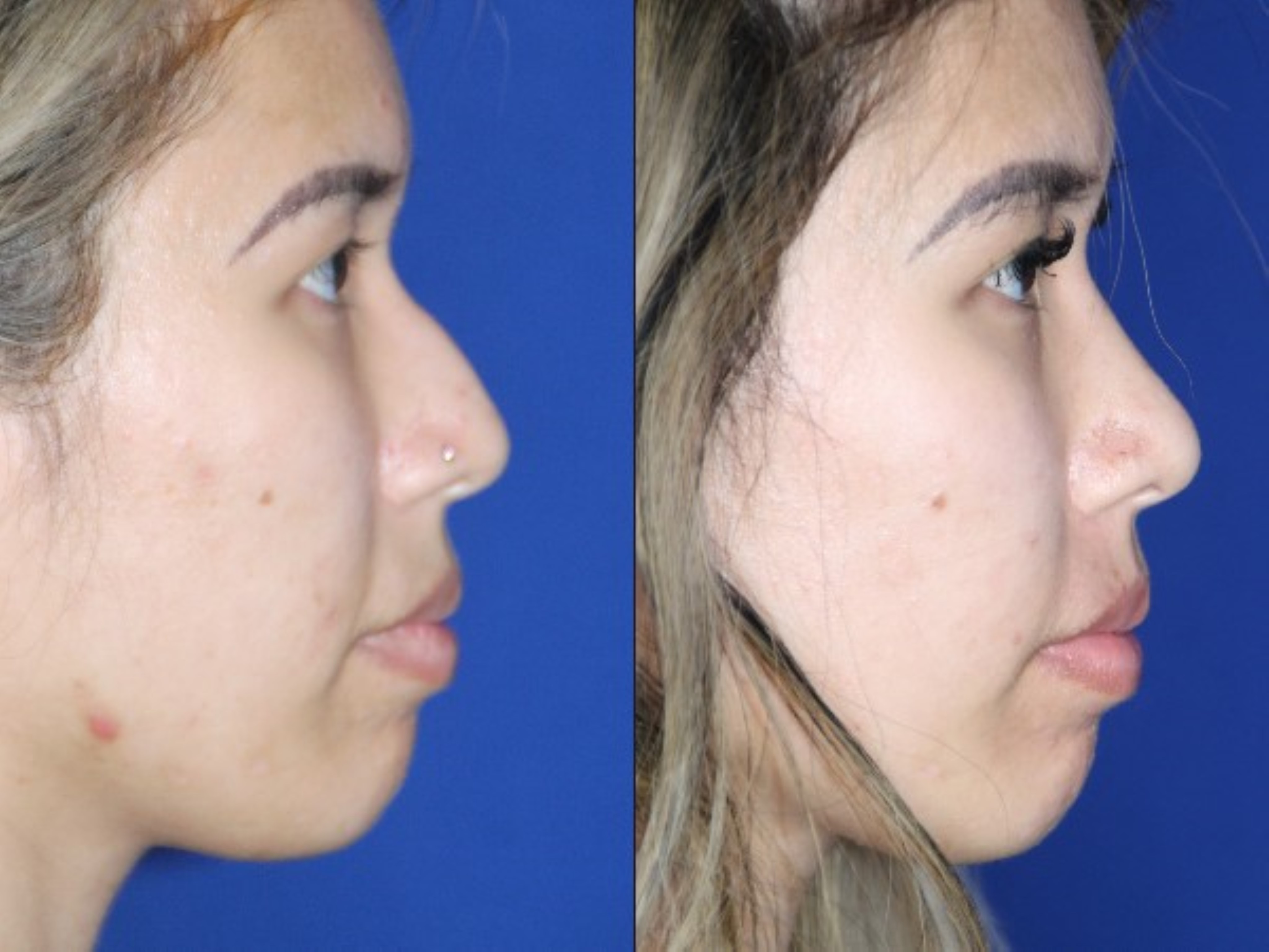 Rhinoplasty before & after &mdash; Patient 8 &mdash; Asian Rhinoplasty