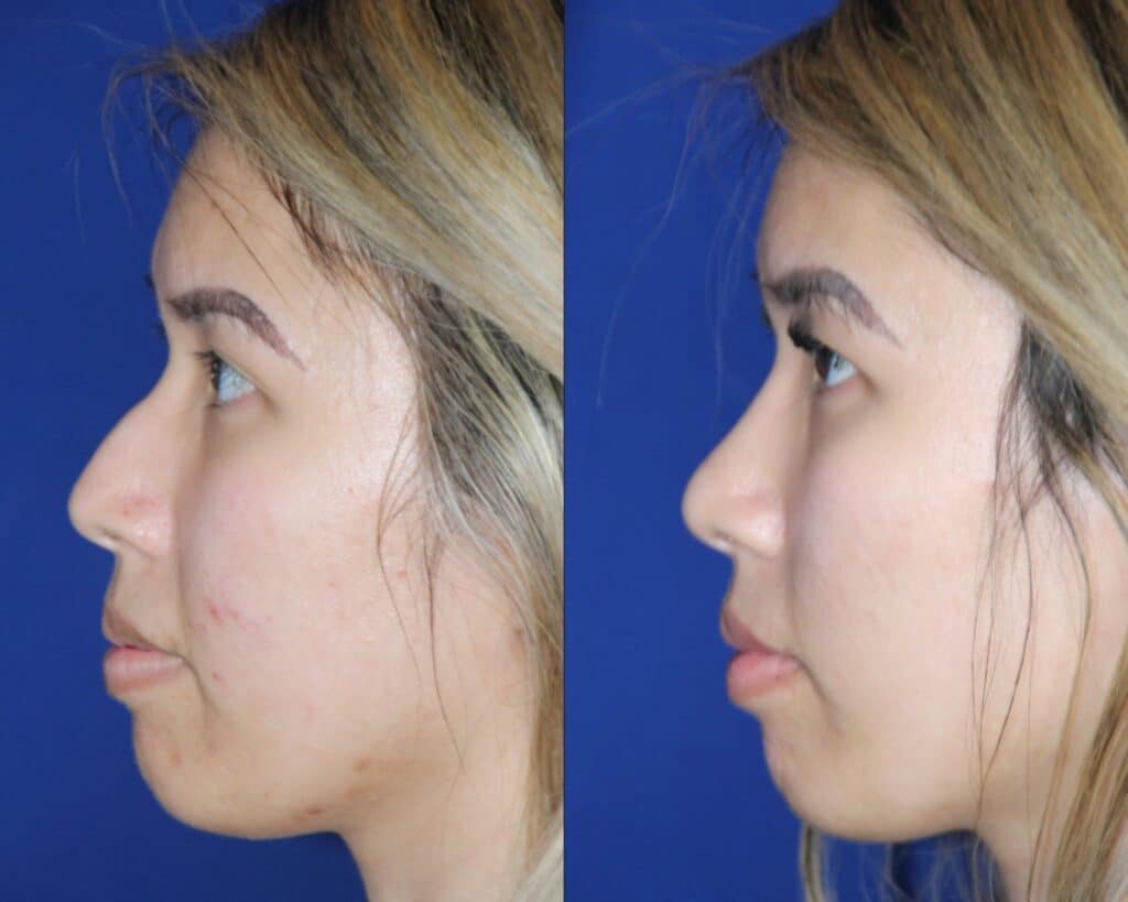 Rhinoplasty before & after &mdash; Patient 8 &mdash; Asian Rhinoplasty
