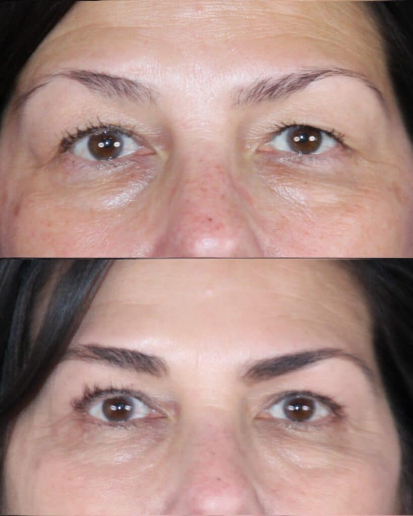 Blepharoplasty before and after &mdash; Patient 10