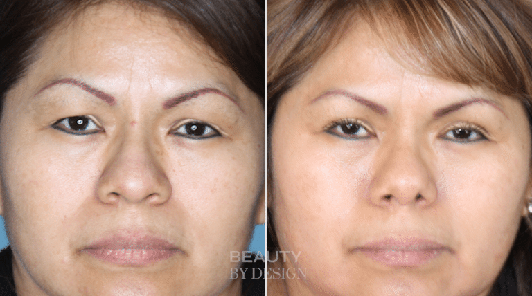 Rhinoplasty front view &mdash; Patient 3 &mdash; Natural Nose Reshaping