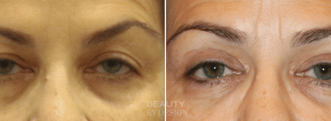 Eyelid rejuvenation before and after &mdash; Patient 6