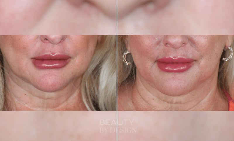 Cervical liposuction before and after &mdash; Patient 5